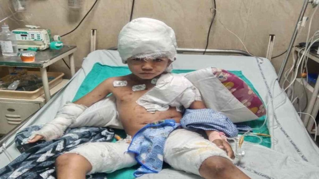 रायपुर में आवारा कुत्तों का हमला, 6 साल के बच्चे की हालत गंभीर