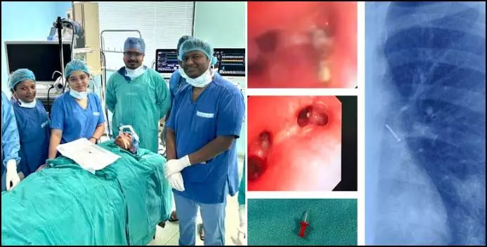 13 साल के बच्चे के फेफड़े से निकली पिन, एम्स रायपुर के डॉक्टरों ने किया कमाल